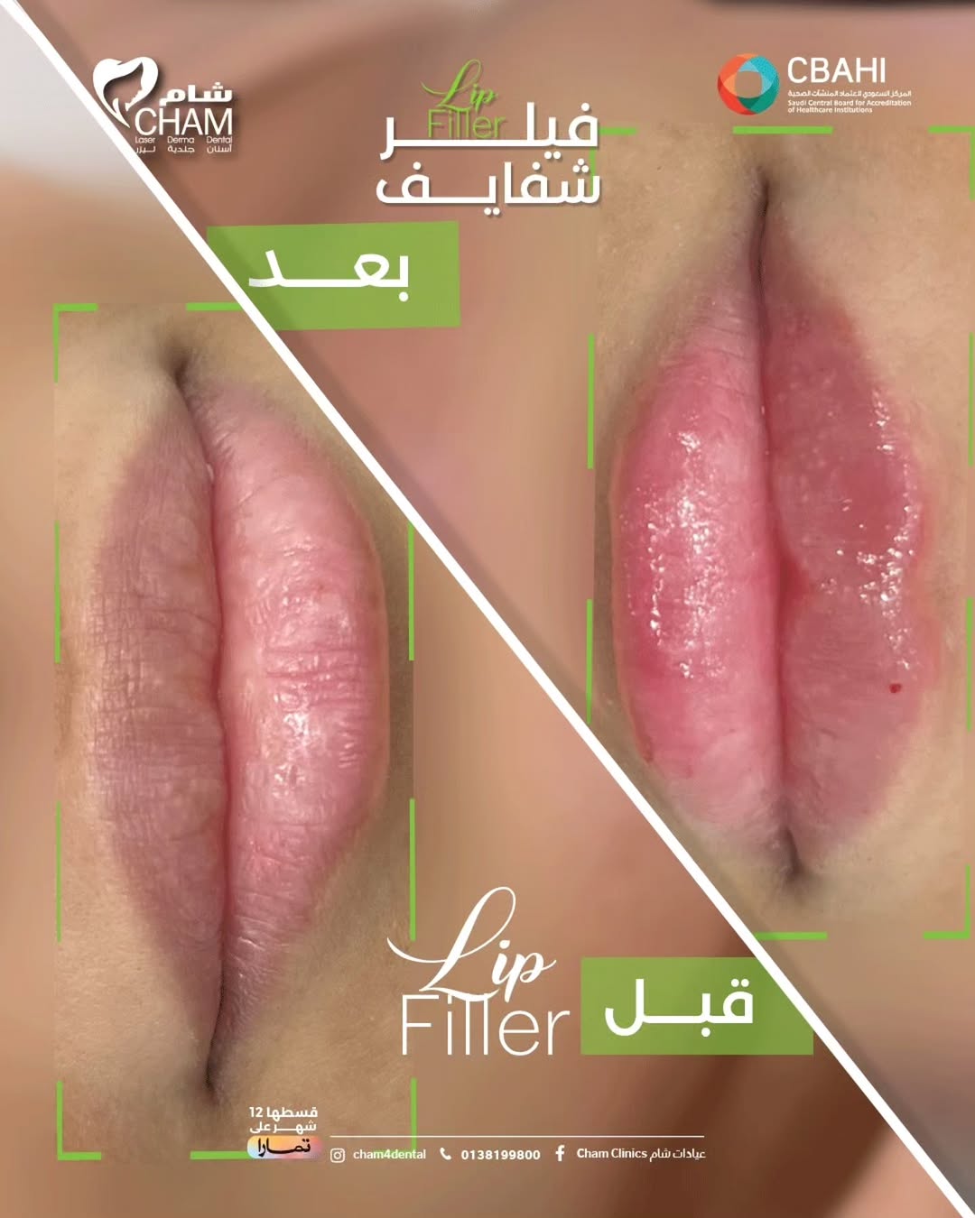 فيلر الشفايف