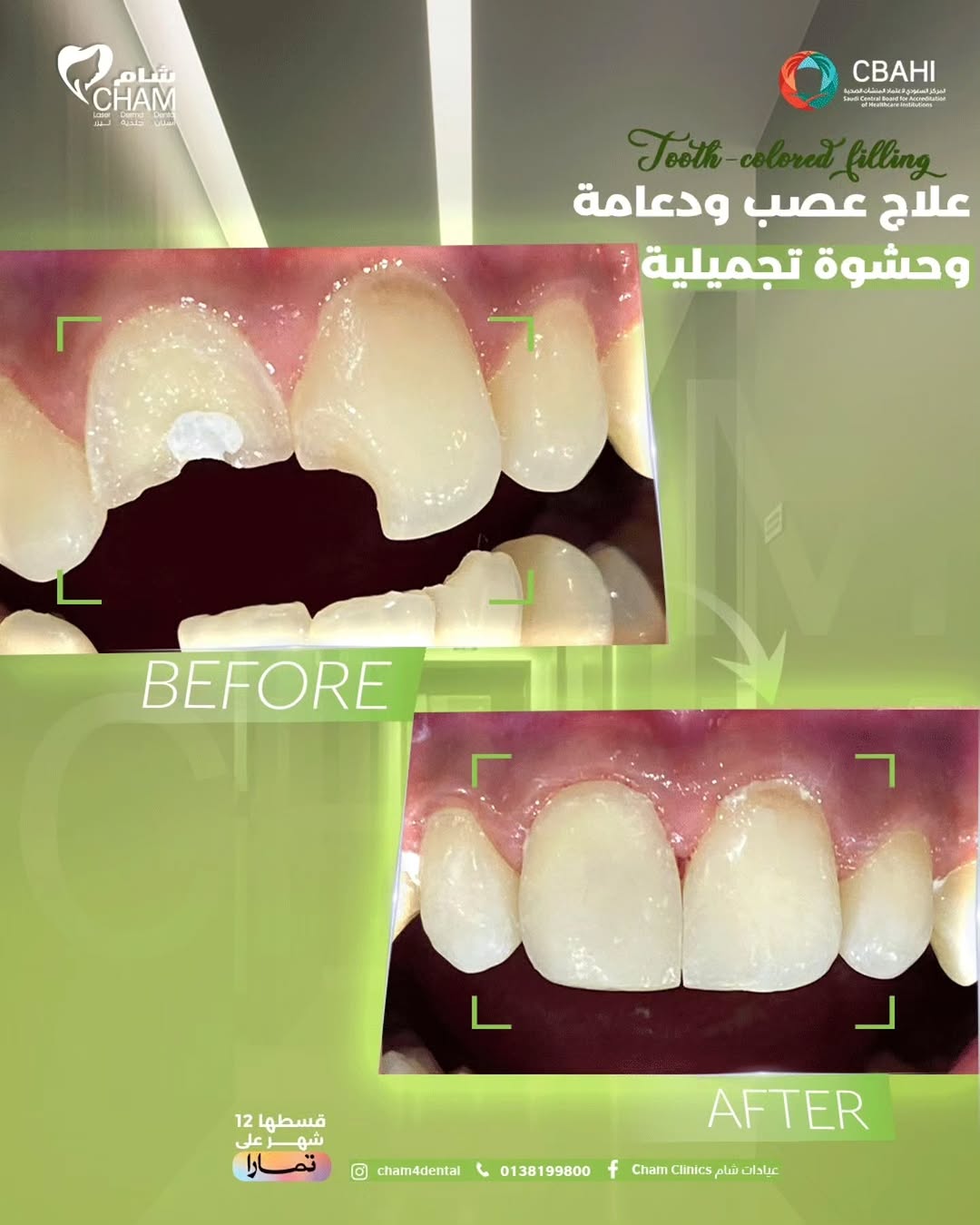 حشو عصب وتجميل