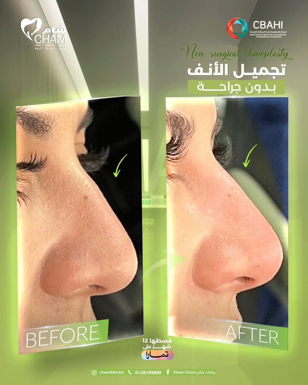 تجميل الأنف بلا جراحة